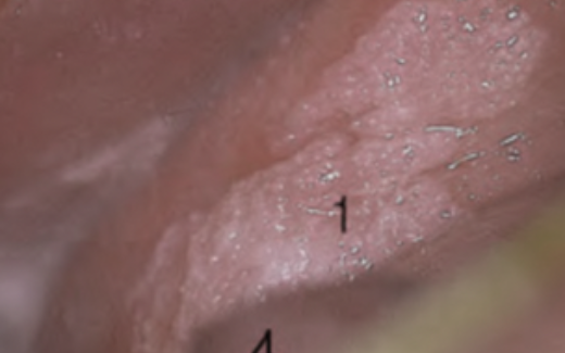 The colposcopic management of women with vaginal lesions