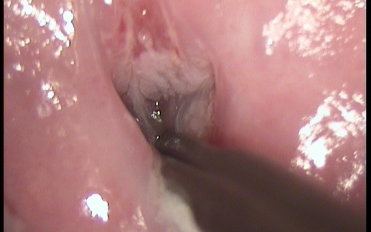 Managing the patient with a Type III Transformation Zone