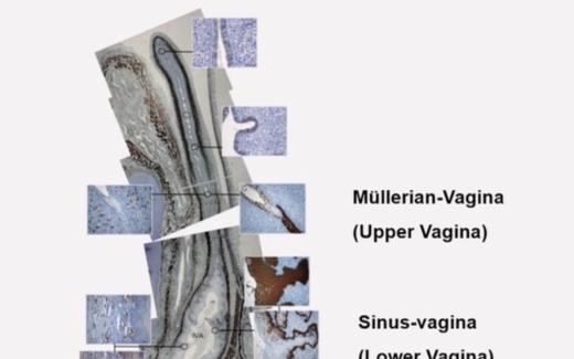 The developmental origin of cervical and vaginal epithelium and their clinical consequences