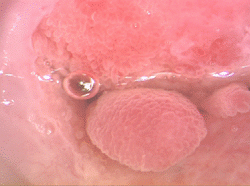 Endocervical polyp