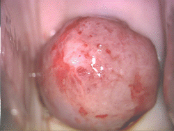 Fibroid polyp