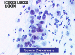 Severe Dyskaryosis